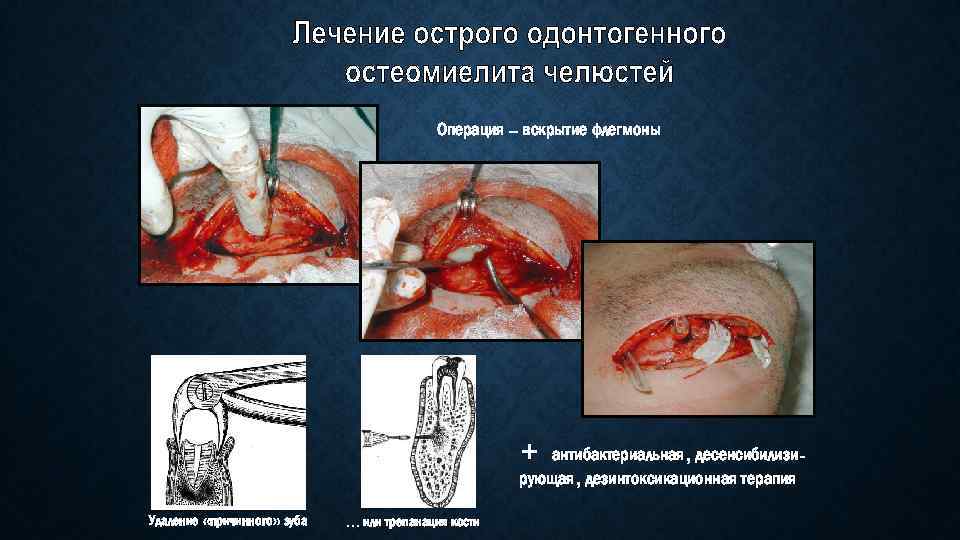 Операция – вскрытие флегмоны + антибактериальная, десенсибилизирующая, дезинтоксикационная терапия Удаление «причинного» зуба … или