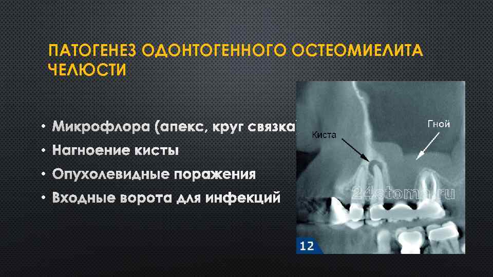 ПАТОГЕНЕЗ ОДОНТОГЕННОГО ОСТЕОМИЕЛИТА ЧЕЛЮСТИ • МИКРОФЛОРА (АПЕКС, КРУГ СВЯЗКА) • НАГНОЕНИЕ КИСТЫ • ОПУХОЛЕВИДНЫЕ