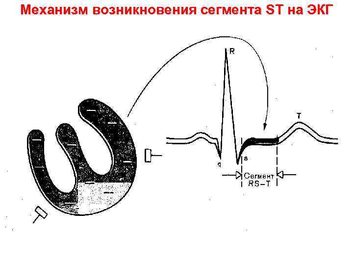 Механизм возникновения сегмента ST на ЭКГ 