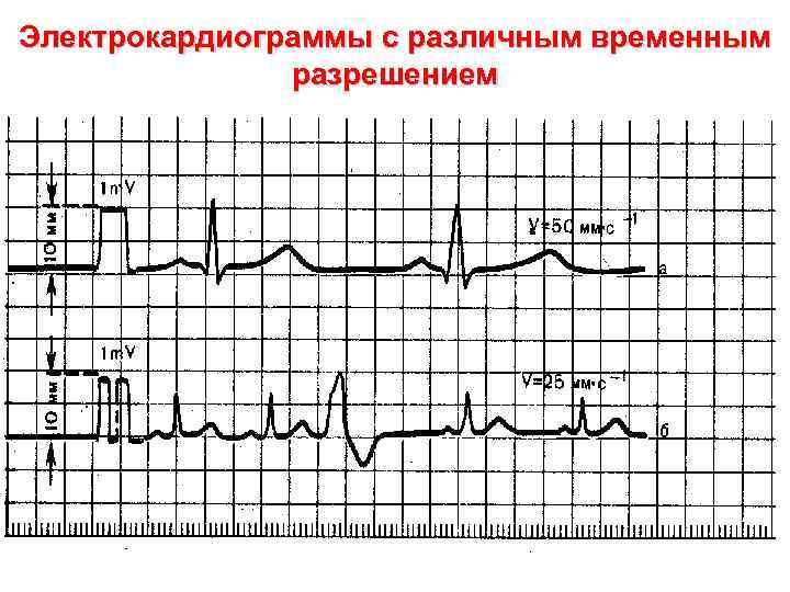 Электрокардиограммы с различным временным разрешением 