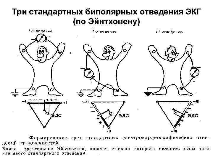 Эйнтховен экг