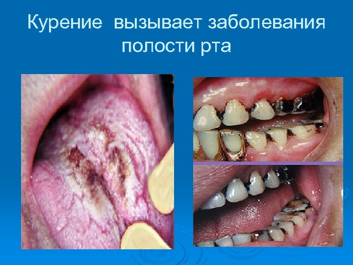 Курение вызывает заболевания полости рта 