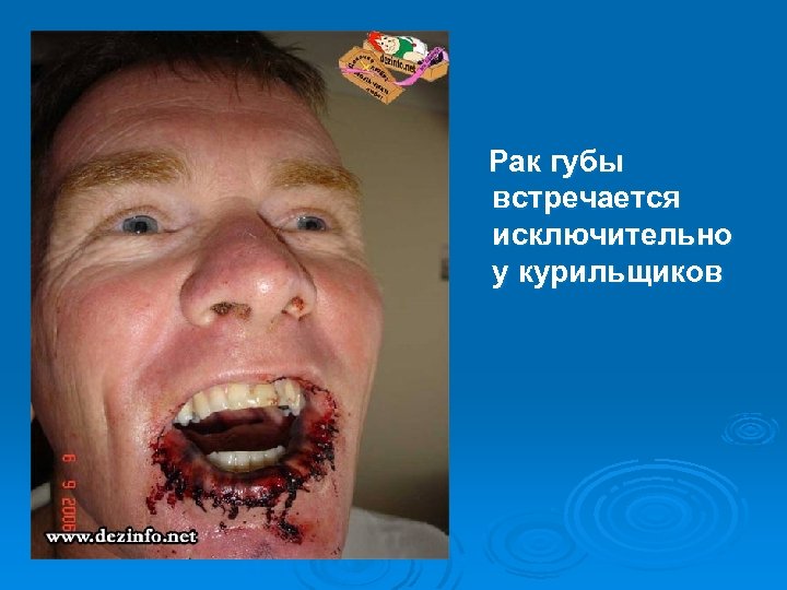 Рак губы встречается исключительно у курильщиков 