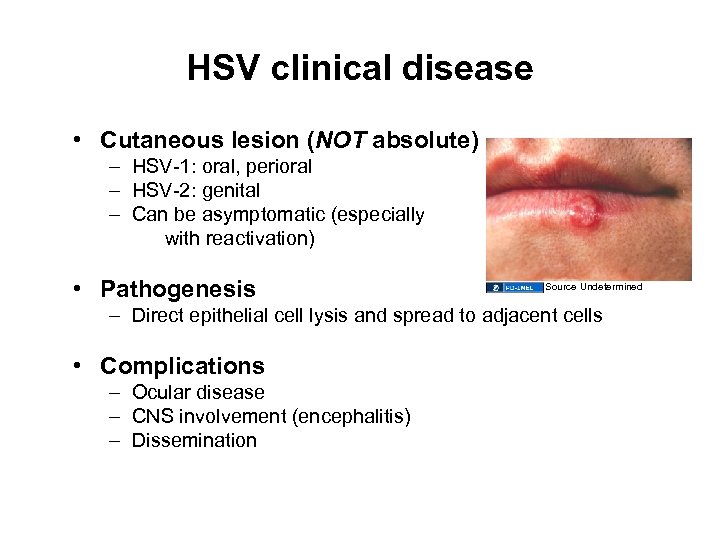 HSV clinical disease • Cutaneous lesion (NOT absolute) – HSV-1: oral, perioral – HSV-2: