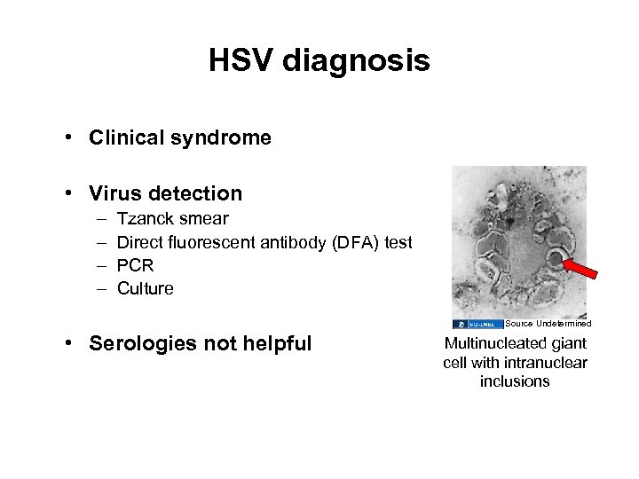 HSV diagnosis • Clinical syndrome • Virus detection – – Tzanck smear Direct fluorescent