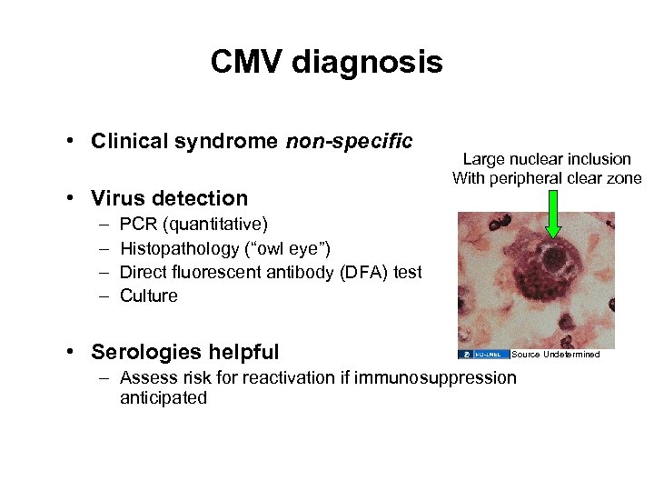 CMV diagnosis • Clinical syndrome non-specific • Virus detection – – Large nuclear inclusion