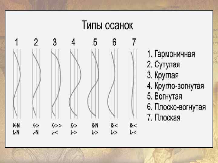 Основные типы осанки а- нормальная осанка; б- кифотическая осанка (круглая спина, сутулая спина); в-