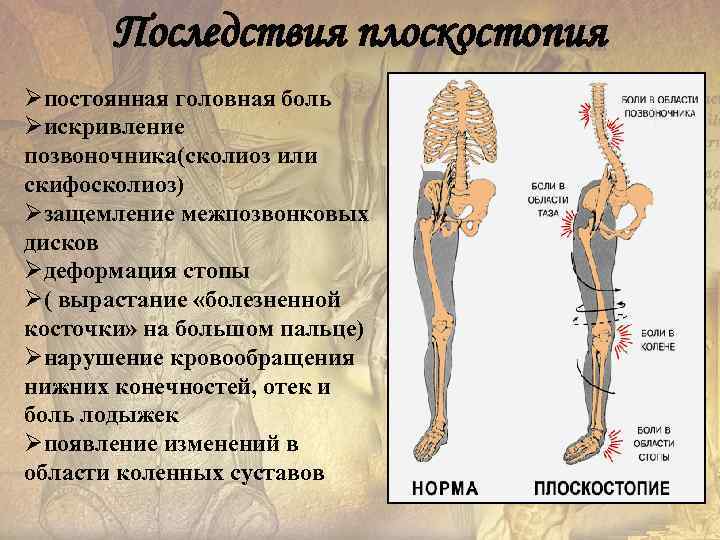 Последствия плоскостопия Øпостоянная головная боль Øискривление позвоночника(сколиоз или скифосколиоз) Øзащемление межпозвонковых дисков Øдеформация стопы