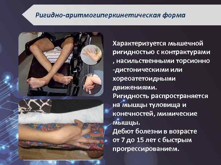 Ригидно-аритмогиперкинетическая форма Характеризуется мышечной ригидностью с контрактурами , насильственными торсионно -дистоническими или хореоатетоидными движениями.