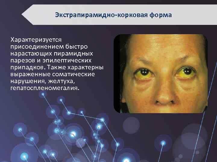 Экстрапирамидно-корковая форма Характеризуется присоединением быстро нарастающих пирамидных парезов и эпилептических припадков. Также характерны выраженные