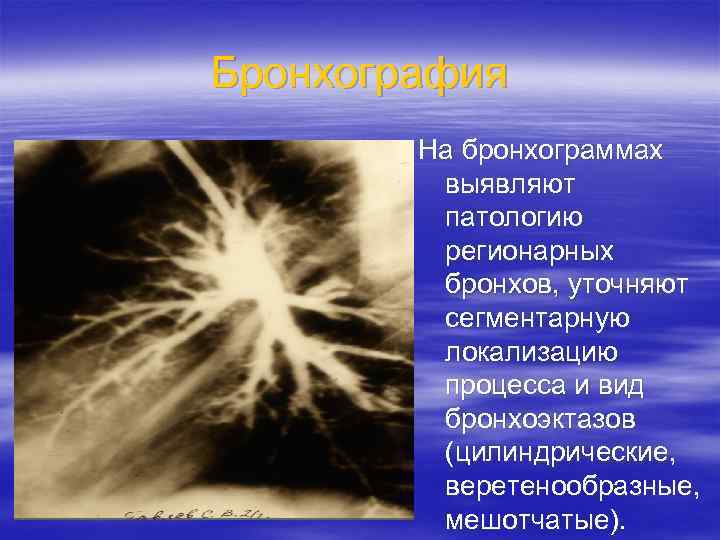 Бронхография На бронхограммах выявляют патологию регионарных бронхов, уточняют сегментарную локализацию процесса и вид бронхоэктазов