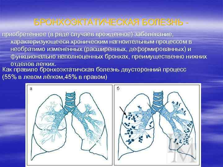 БРОНХОЭКТАТИЧЕСКАЯ БОЛЕЗНЬ приобретенное (в ряде случаев врожденное) заболевание, характеризующееся хроническим нагноительным процессом в необратимо
