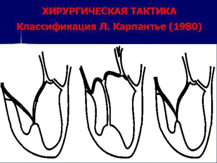 ХИРУРГИЧЕСКАЯ ТАКТИКА Классификация Л. Карпантье (1980) 