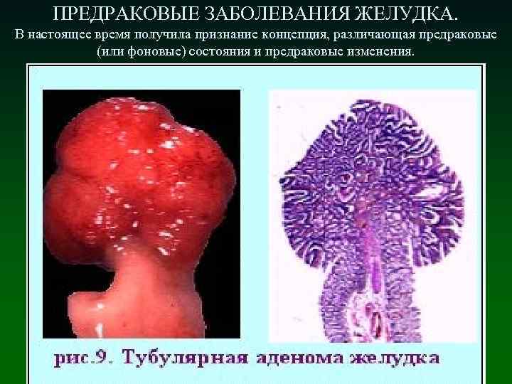 ПРЕДРАКОВЫЕ ЗАБОЛЕВАНИЯ ЖЕЛУДКА. В настоящее время получила признание концепция, различающая предраковые (или фоновые) состояния