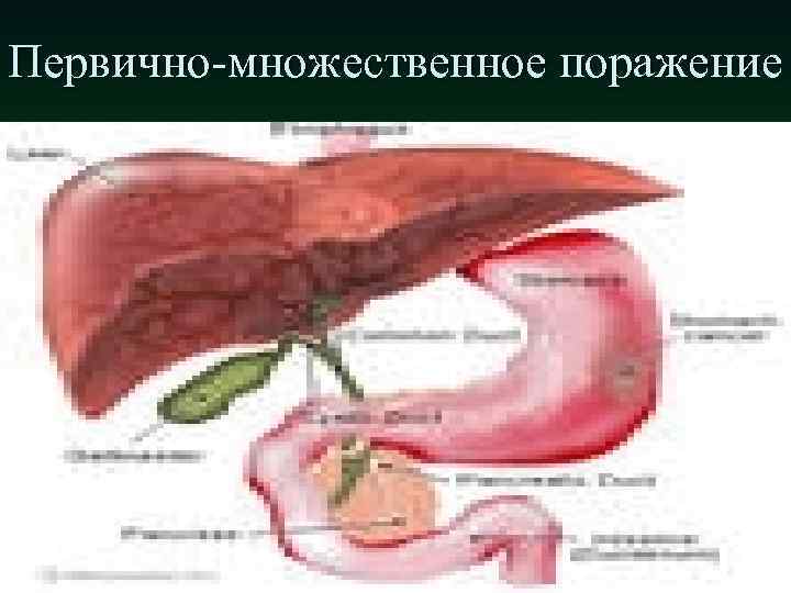 Первично-множественное поражение 