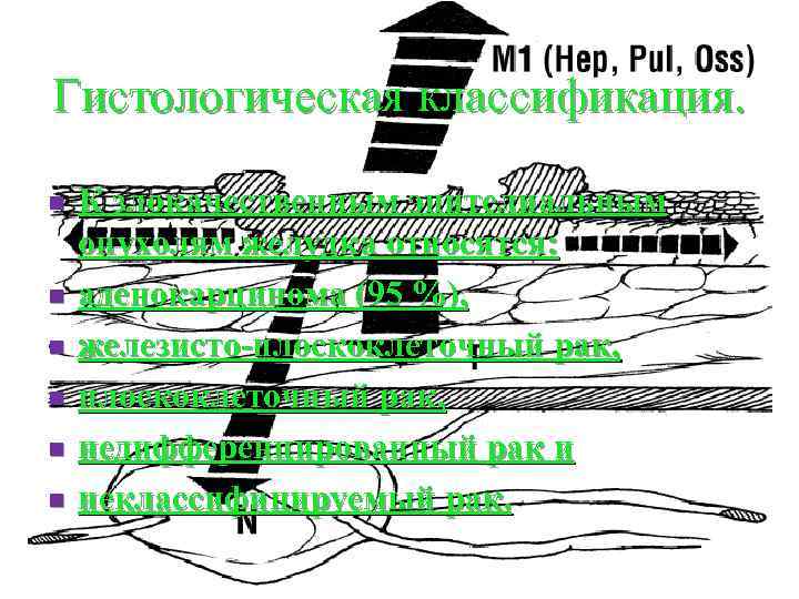 Гистологическая классификация. n n n К злокачественным эпителиальным опухолям желудка относятся: аденокарцинома (95 %),