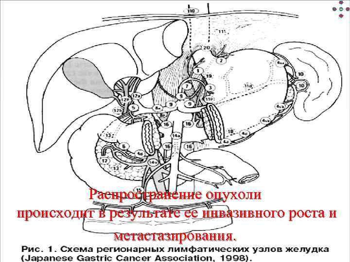 Лимфогенное метастазирование Гематогенное метастазирование Распросранение опухоли Имплантационное метастазирование. Обсеменение Распространение опухоли происходит в результате