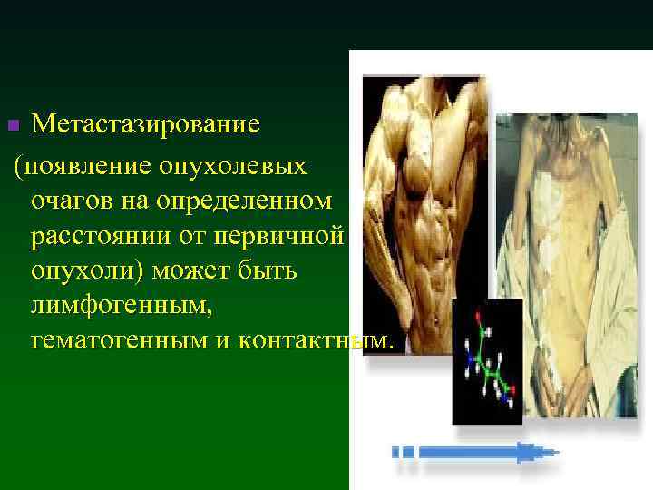 Метастазирование (появление опухолевых очагов на определенном расстоянии от первичной опухоли) может быть лимфогенным, гематогенным