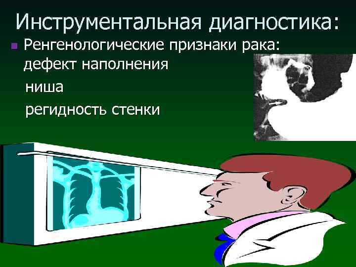 Инструментальная диагностика: Ренгенологические признаки рака: дефект наполнения ниша регидность стенки n 