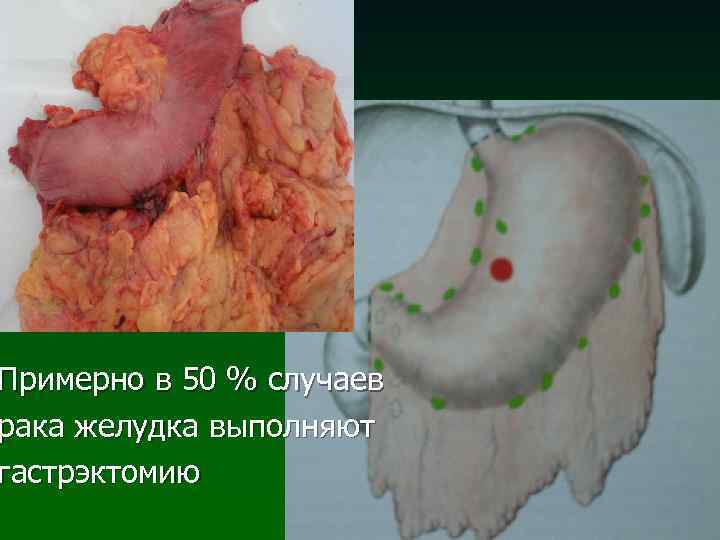 Примерно в 50 % случаев рака желудка выполняют гастрэктомию 