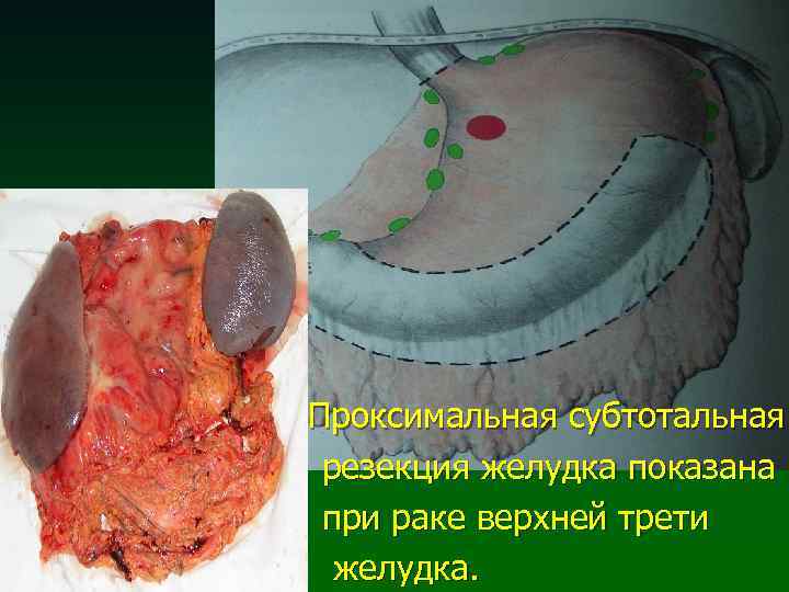 Проксимальная субтотальная резекция желудка показана при раке верхней трети желудка. n 