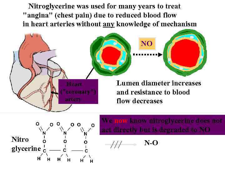 Nitroglycerine was used for many years to treat "angina" (chest pain) due to reduced