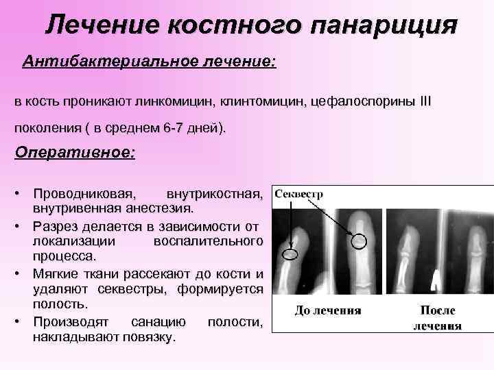  Лечение костного панариция Антибактериальное лечение: в кость проникают линкомицин, клинтомицин, цефалоспорины III поколения