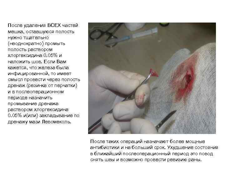 После удаления ВСЕХ частей мешка, оставшуюся полость нужно тщательно (неоднократно) промыть полость раствором хлоргексидина