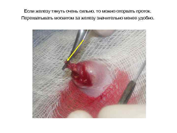 Если железу тянуть очень сильно, то можно оторвать проток. Перехватывать москитом за железу значительно
