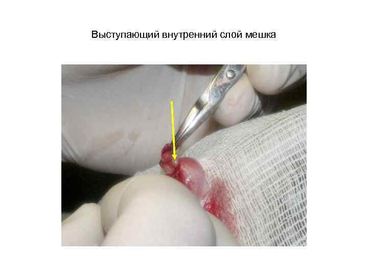 Выступающий внутренний слой мешка 