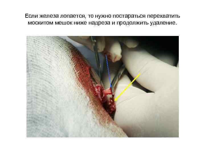 Если железа лопается, то нужно постараться перехватить москитом мешок ниже надреза и продолжить удаление.