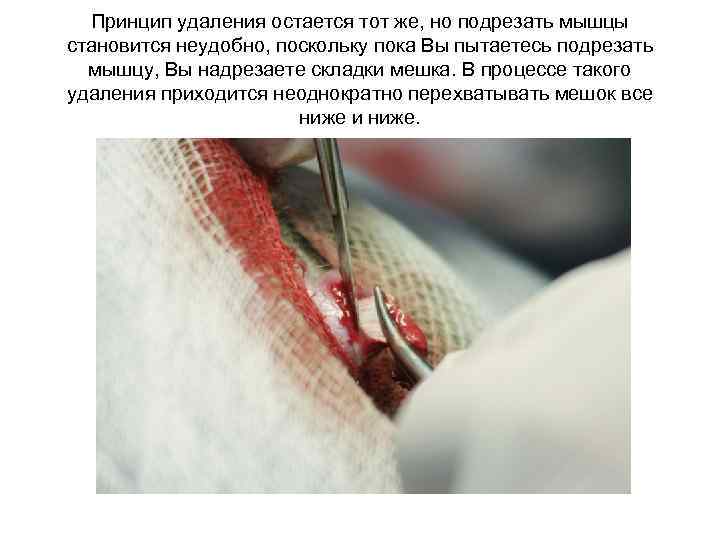 Принцип удаления остается тот же, но подрезать мышцы становится неудобно, поскольку пока Вы пытаетесь