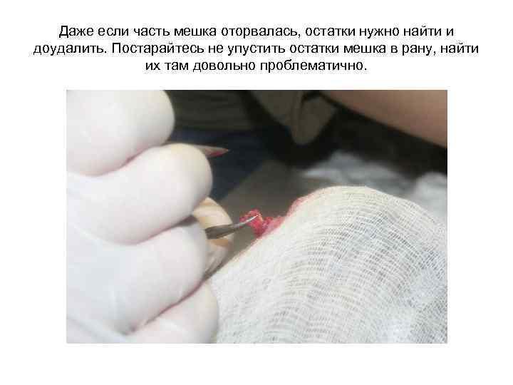 Даже если часть мешка оторвалась, остатки нужно найти и доудалить. Постарайтесь не упустить остатки