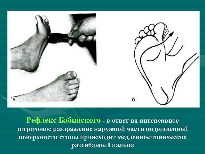 Рефлекс Бабинского - в ответ на интенсивное штриховое раздражение наружной части подошвенной поверхности стопы