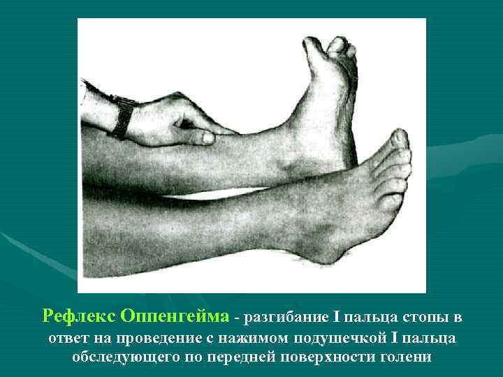 Рефлекс Оппенгейма - разгибание I пальца стопы в ответ на проведение с нажимом подушечкой