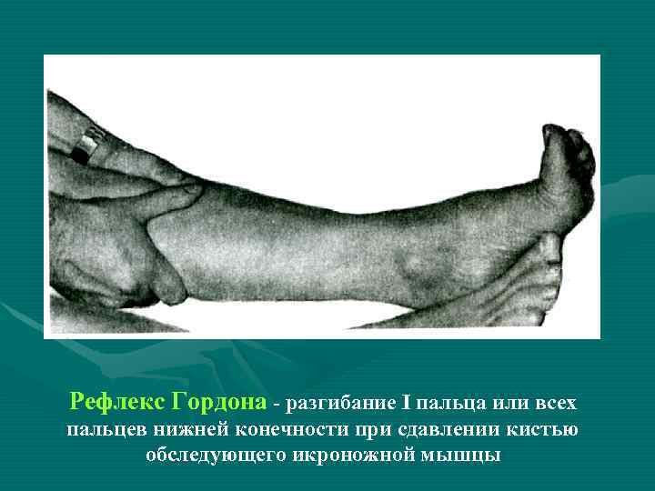 Рефлекс Гордона - разгибание I пальца или всех пальцев нижней конечности при сдавлении кистью