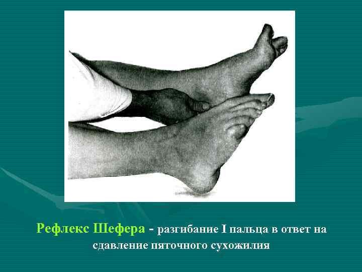Рефлекс Шефера - разгибание I пальца в ответ на сдавление пяточного сухожилия 