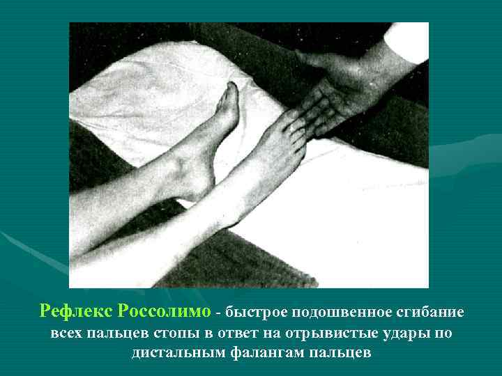 Рефлекс Россолимо - быстрое подошвенное сгибание всех пальцев стопы в ответ на отрывистые удары