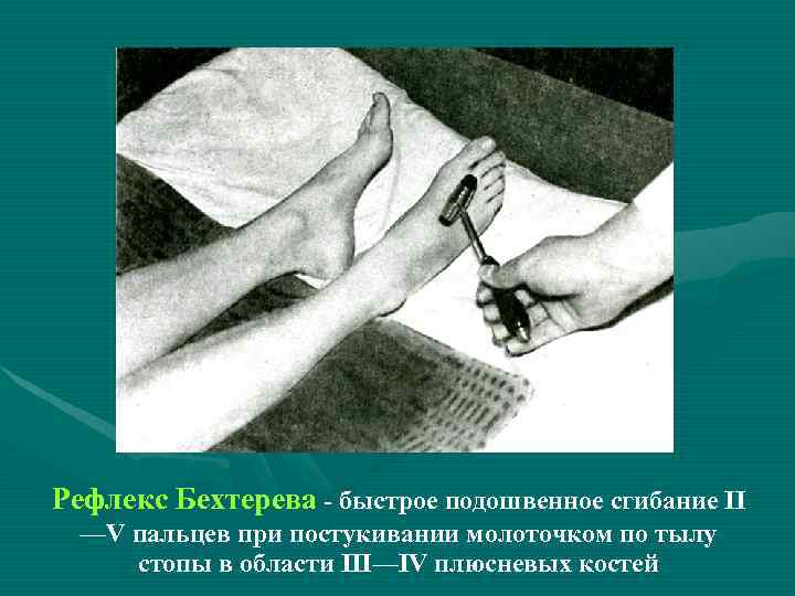 Рефлекс Бехтерева - быстрое подошвенное сгибание II —V пальцев при постукивании молоточком по тылу