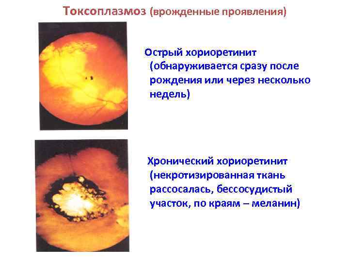 Токсоплазмоз (врожденные проявления) Острый хориоретинит (обнаруживается сразу после рождения или через несколько недель) Хронический
