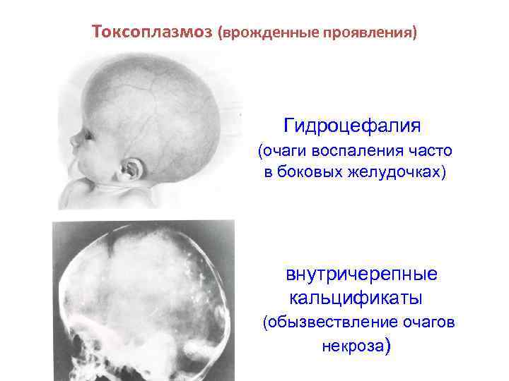 Токсоплазмоз (врожденные проявления) Гидроцефалия (очаги воспаления часто в боковых желудочках) внутричерепные кальцификаты (обызвествление очагов