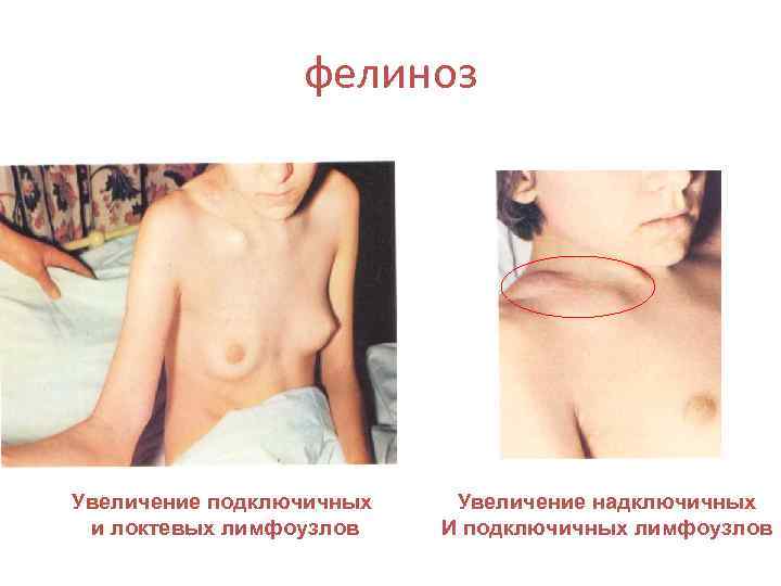 фелиноз Увеличение подключичных и локтевых лимфоузлов Увеличение надключичных И подключичных лимфоузлов 