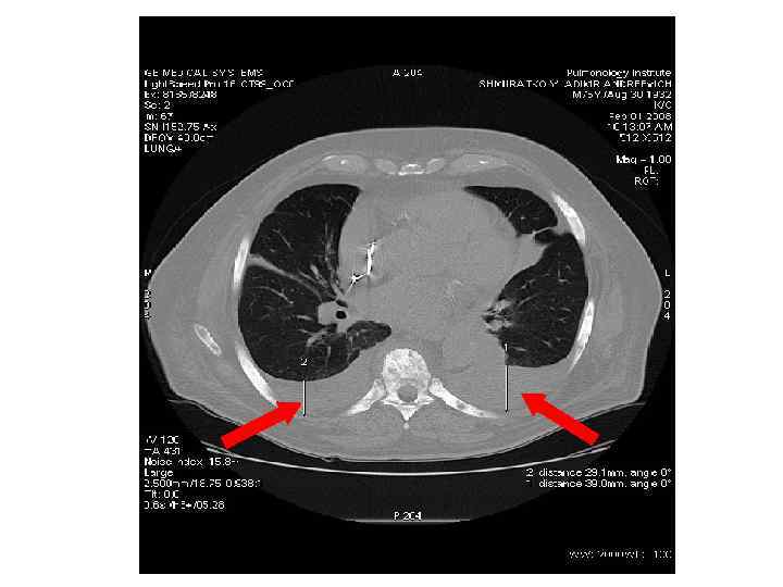 Плевральные изменения 