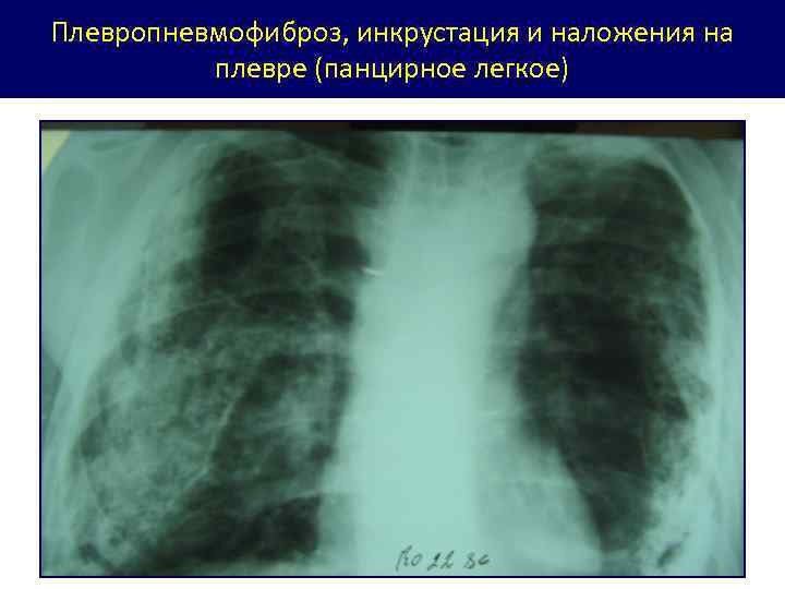 Плевропневмофиброз, инкрустация и наложения на плевре (панцирное легкое) 