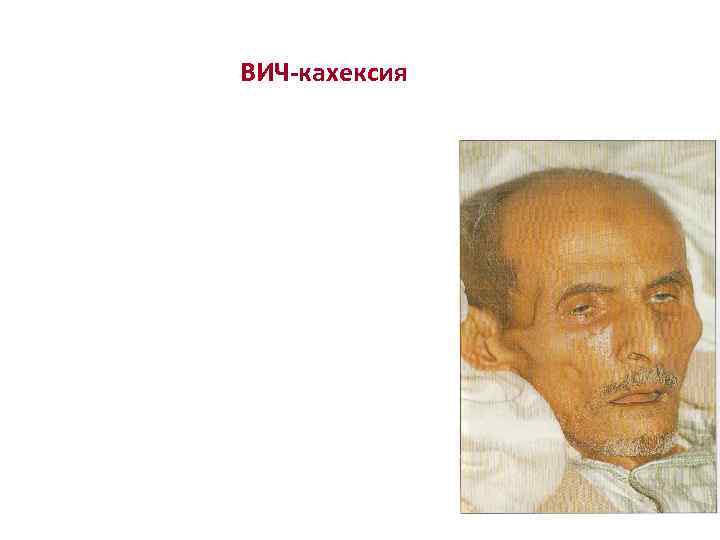 ВИЧ-кахексия 