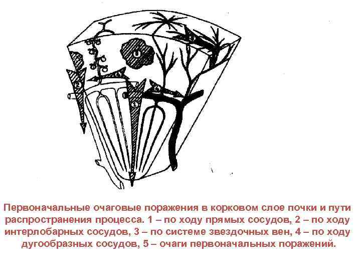 Первоначальные очаговые поражения в корковом слое почки и пути распространения процесса. 1 – по
