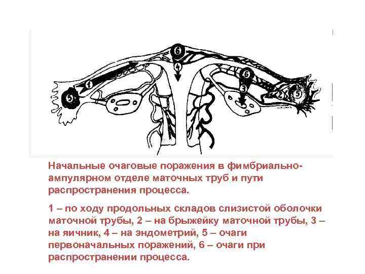 Начальные очаговые поражения в фимбриальноампулярном отделе маточных труб и пути распространения процесса. 1 –