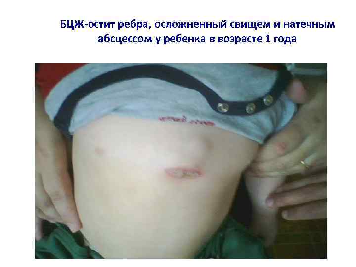 БЦЖ-остит ребра, осложненный свищем и натечным абсцессом у ребенка в возрасте 1 года 