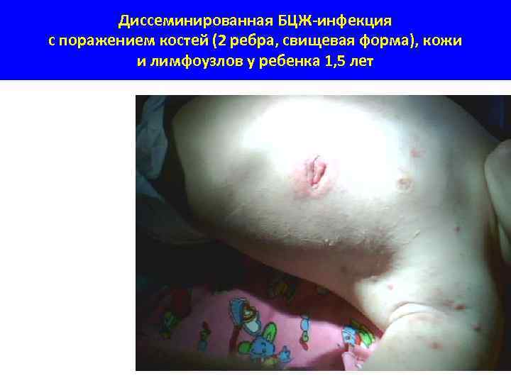 Диссеминированная БЦЖ-инфекция с поражением костей (2 ребра, свищевая форма), кожи и лимфоузлов у ребенка