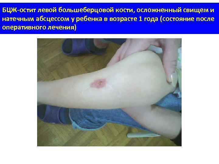 БЦЖ-остит левой большеберцовой кости, осложненный свищем и натечным абсцессом у ребенка в возрасте 1